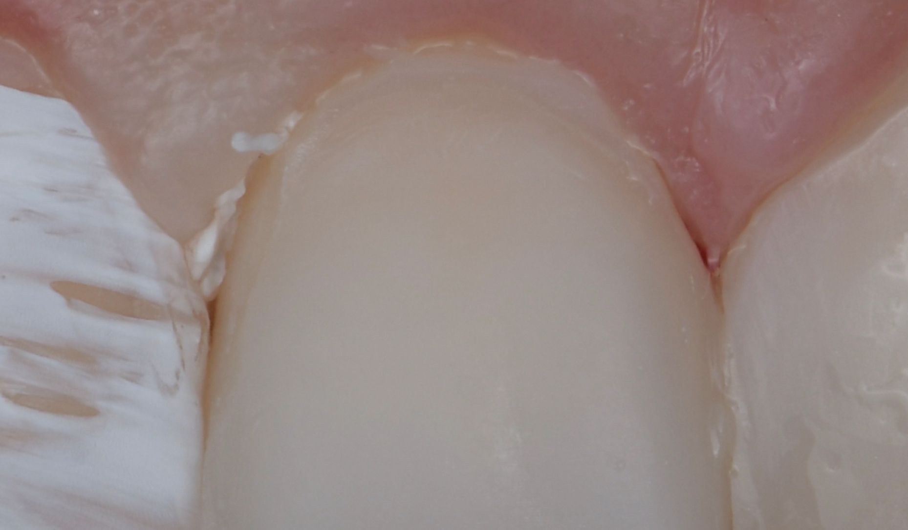 Figure 7b: Composite surface with a defect near the margin after thorough rinsing and drying.